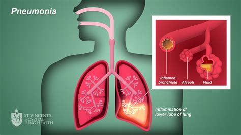 pnemonia's symptoms are similar to those of the flu